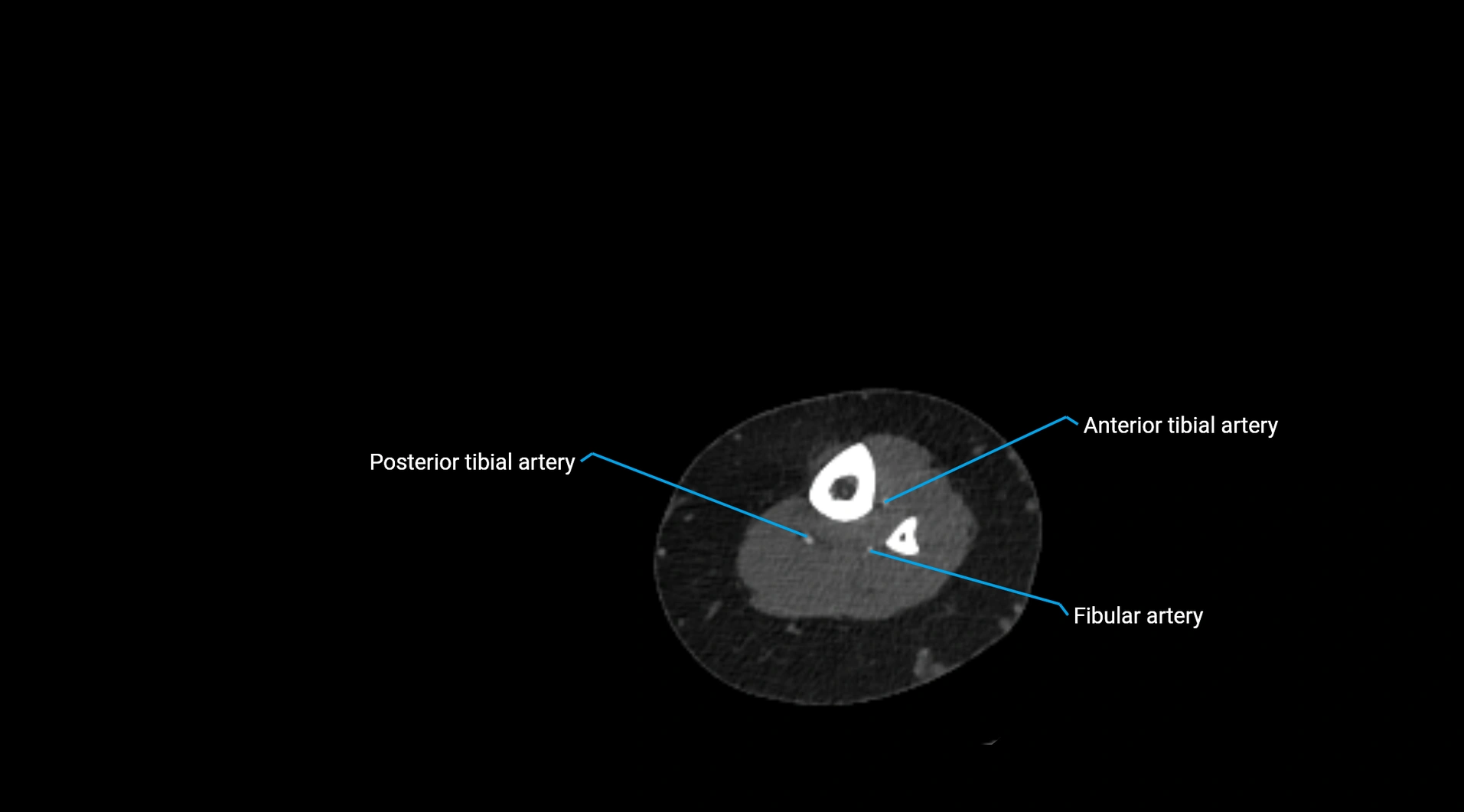 CTA lower limb cross sectional anatomy labelled image _230.webp